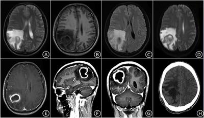 A Clinical Report of Two Cases of Cryptogenic Brain Abscess and a Relevant Literature Review